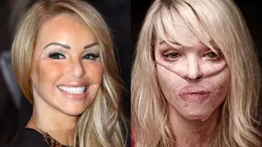 Presentadora de TV que fue atacada con ácido cuenta la pesadilla que vivió Presentadora de TV que fue atacada con ácido cuenta la pesadilla que vivió