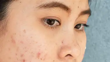 5 recomendaciones para evitar las enfermedades de la piel 5 recomendaciones para evitar las enfermedades de la piel