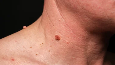 ¿Por qué salen verrugas en el cuello? Lo que debes saber sobre su aparición