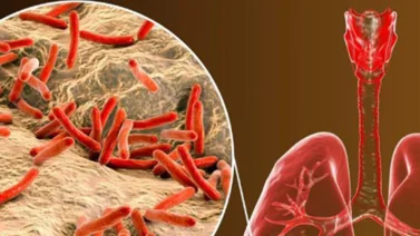 ¿Cuánto tiempo vive una persona con tuberculosis? 