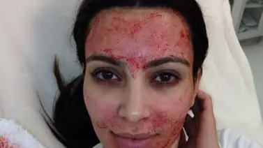 Faciales Vampiro: Un tratamiento rejuvenecedor que te dará un brillo "eterno"