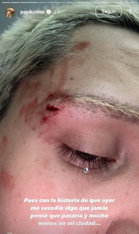 Golpean a Kunno: Influencer denuncia ataque homofóbico - Golpean a Kunno: Influencer denuncia ataque homofóbico