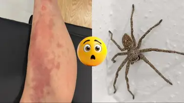 Estrella de la música es hospitalizada por picadura de araña venenosa Estrella de la música es hospitalizada por picadura de araña venenosa
