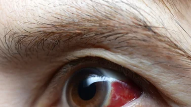 Derrame en el ojo por estrés: ¿Puede  dejarte ciego? ¿Cuáles son su causas y cómo prevenirlo? 