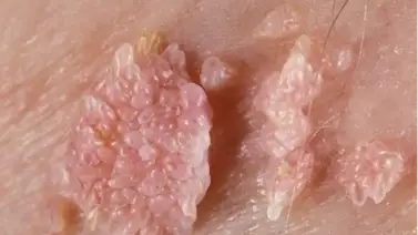 ¿Altamente contagiosos? Todo sobre el virus del papiloma humano ¿Altamente contagiosos? Todo sobre el virus del papiloma humano