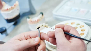 Aprende cómo son los puentes dentales y cuál es su verdadera función
