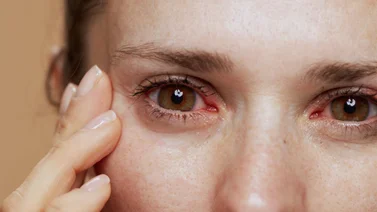 Estos son los remedios caseros para los ojos rojos según la American Academy of Ophthalmology