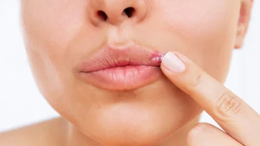 ¿En problemas? Medical News Today te enseña cómo quitar herpes labial en una noche