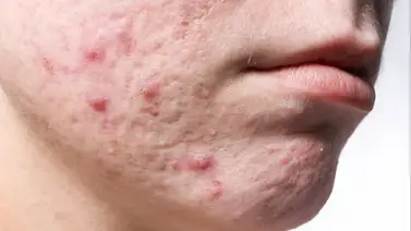 Acné: Estos son los diferentes tipos que se pueden producir en la cara Acné: Estos son los diferentes tipos que se pueden producir en la cara