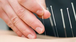 ¿Para qué sirve la acupuntura? Un tesoro milenario para el bienestar y la salud