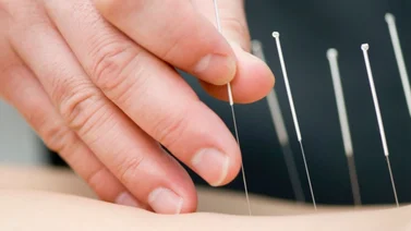 ¿Para qué sirve la acupuntura? Un tesoro milenario para el bienestar y la salud