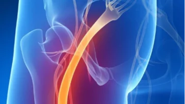 ¿Te duele el nervio ciático? Con estos ejercicios en casa puedes aliviar el dolor