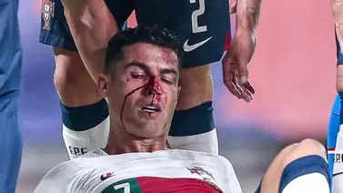A Cristiano Ronaldo le rompieron la nariz en el partido ante República Checa A Cristiano Ronaldo le rompieron la nariz en el partido ante República Checa