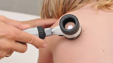 Anuncian fecha de Jornada de Prevención de Cáncer de Piel