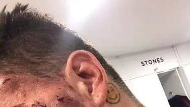 Así quedó el rostro de Ederson tras la patada de Mané (+FOTO) Así quedó el rostro de Ederson tras la patada de Mané (+FOTO)