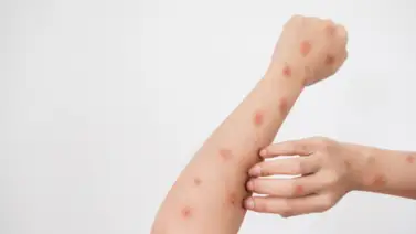 Detectan el primer caso de mpox o "viruela del mono" en Suecia (+Detalles) Detectan el primer caso de mpox o "viruela del mono" en Suecia (+Detalles)