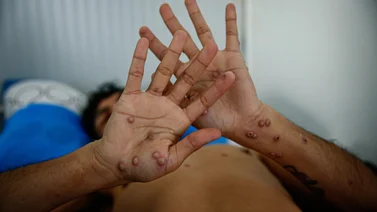 Detectan los primeros casos de viruela del mono en Argentina
