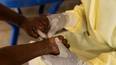 ¡Alerta! Reportan primer caso de Mpox fuera de África