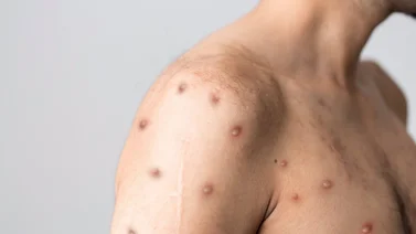 Cómo prevenir contagiarte de la viruela del mono