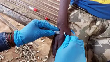 Viruela del mono: La OMS anuncia plan global contra el Mpox Viruela del mono: La OMS anuncia plan global contra el Mpox