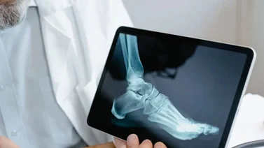 fracturas en tibia y pie 