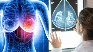 ¿Debo considerar una cirugía de reconstrucción del seno luego del cáncer? (+Video)