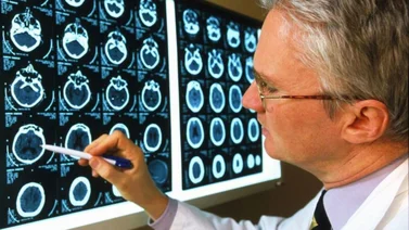 Estudio revela dos fases en el daño cerebral causado por el Alzheimer