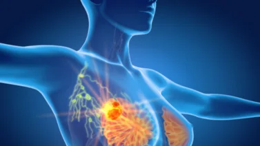 Costos de Exámenes para Detectar el Cáncer de Mama en Caracas: 