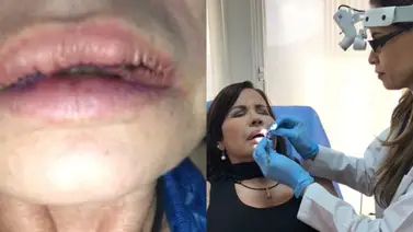 Ivette Domínguez se sincera sobre que la llevó a "destruir" su cara con biopolímeros Ivette Domínguez se sincera sobre que la llevó a "destruir" su cara con biopolímeros