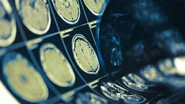 Conoce la nueva herramienta IA para detectar tumores cerebrales en segundos