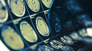 Conoce la nueva herramienta IA para detectar tumores cerebrales en segundos